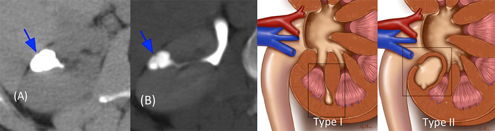 Calyceal Diverticulum